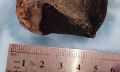 В Бурятии у пенсионерки обнаружили 5-сантиметровый желчный камень