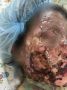 Врачи в Бурятии спасли ребёнка с редким и смертельно опасным синдромом Лайелла